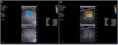 A Nomogram Predicting the Prognosis of Children With Biliary Atresia After Hepatoportoenterostomy